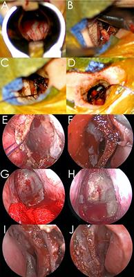 A Modified Microscopic-Endoscopic Bilateral Transseptal Approach for Pituitary Adenomas: Comparisons of Nasal Outcome and Quality of Life Using the Microscopic Transnasal Approach